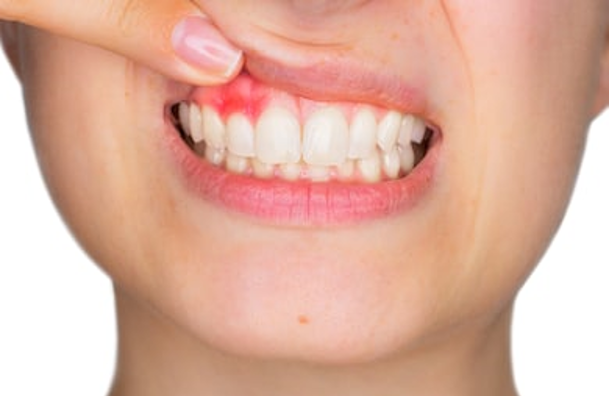 ¿Si tengo periodontitis puedo usar Invisalign?